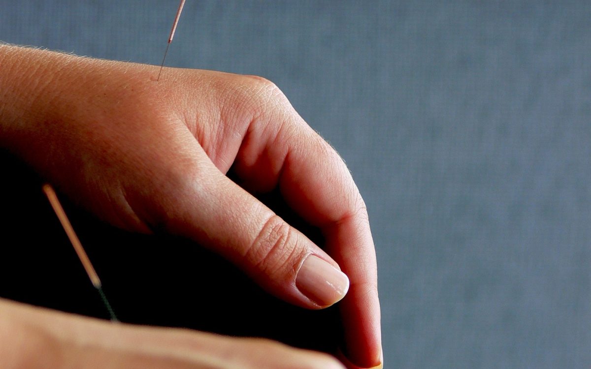 Aplicación de agujas de acupuntura. Fotografía referencial; no corresponde al hospital de la noticia.