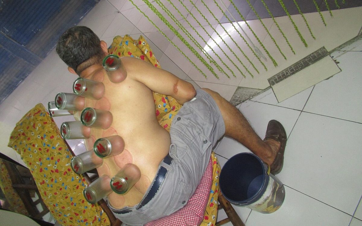 https://en.wikipedia.org/wiki/Cupping_therapy Cupping therapy, Ventosa in Healing
