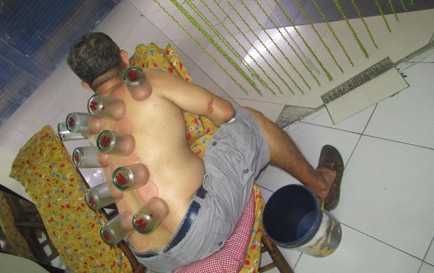 https://en.wikipedia.org/wiki/Cupping_therapy Cupping therapy, Ventosa in Healing